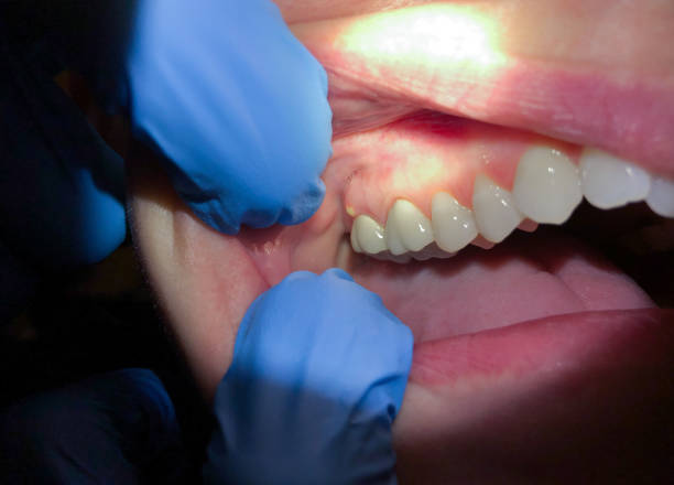 Best Emergency Dentist for Lost Fillings or Crowns in Three Oaks, MI